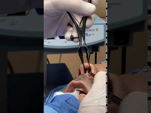 Septoplasty - Septal Incision