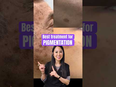 The Best Treatment for Pigmentation