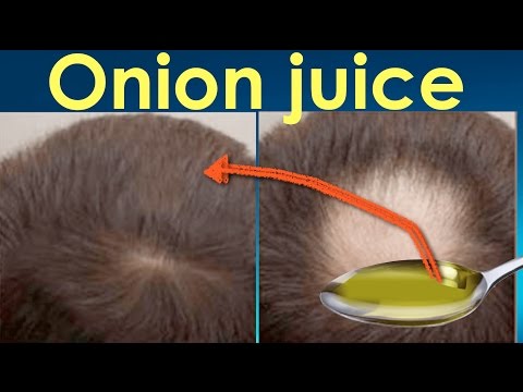 Onion juice for hair regrowth before and after/ Onion juice results for hair regrowth and hair loss