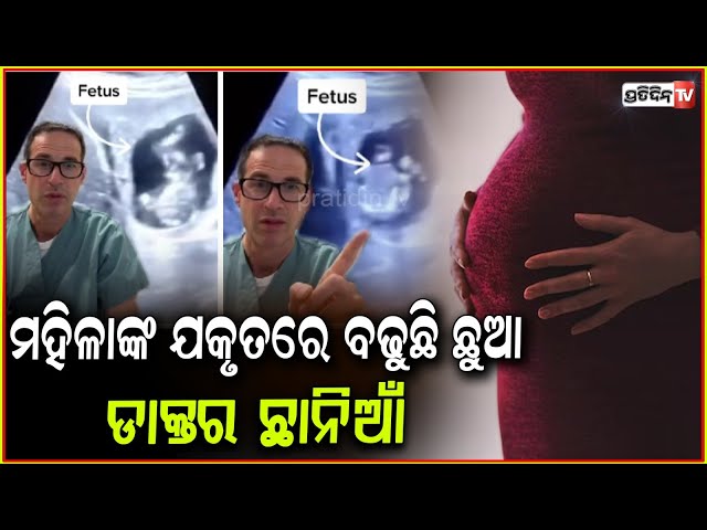ଗର୍ଭାଶୟ ବଦଳରେ ଲିଭର ରେ ବଢୁଛି ଭୃଣ, ଆଶ୍ଚର୍ଯ୍ୟ ହେଇଗଲେ ଡାକ୍ତର ! Baby grows in woman's liver