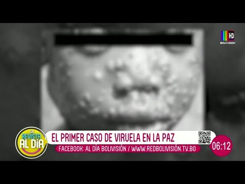 Viruela del mono: Primer caso en La Paz