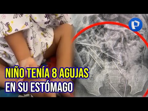 Tarapoto: ¡increíble! niño de 2 años tenía ocho agujas en su estómago