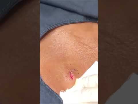 It's like butta  ✌️❤️💥 #shorts #drpimplepopper