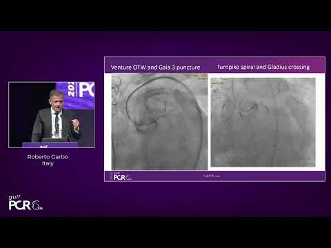 Complex CTOs in CHIP  - GulfPCR-GIM 2022