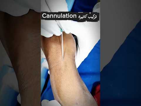 Cannula insertion #nurse