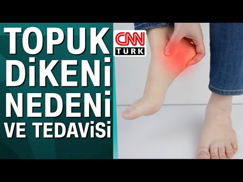 Topuk dikeni neden olur? Tedavisi nasıl yapılır?