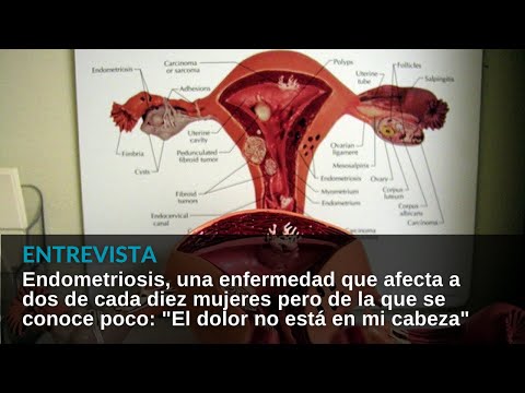 Endometriosis, una enfermedad que afecta a dos de cada diez mujeres pero de la que se conoce poco