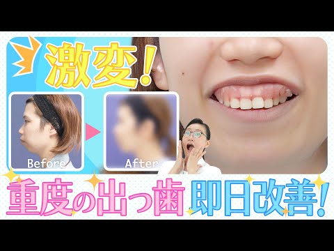 激変‼️重度の出っ歯即日改善✨
