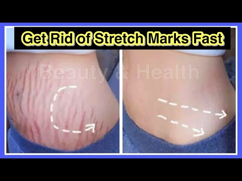 How-To-Get-Rid-of-Stretch-Mark How-To-Get-Rid-of-Stretch-Mark