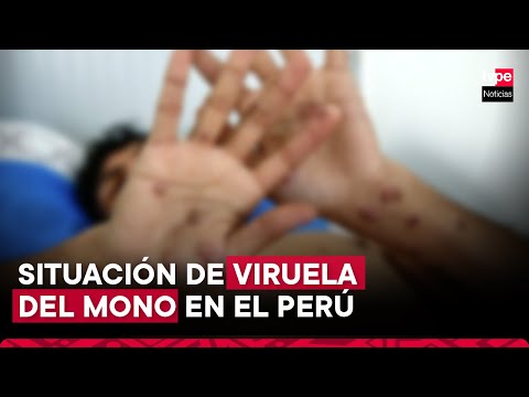 Emergencia mundial por viruela del mono: Perú no reporta casos de la nueva variante