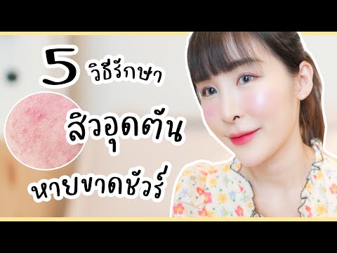 5-วิธีรักษา-สิวอุดตัน-ยังไง-ให 5-วิธีรักษา-สิวอุดตัน-ยังไง-ให