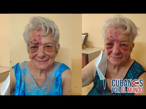 ¿Potencia médica Pide un medicamentos para curar a anciana cubana con culebrilla