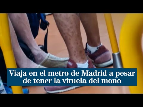 Viaja en el metro de Madrid a pesar de estar contagiado de viruela del mono