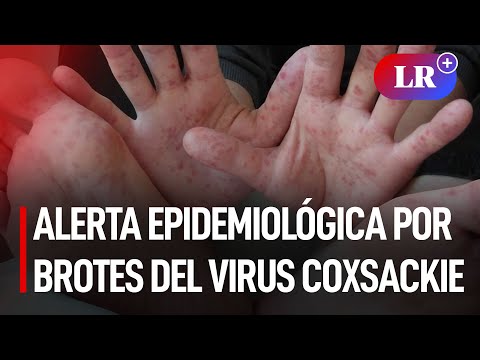 Minsa: 4 regiones en alerta epidemiológica por brotes del virus coxsackie | #LR