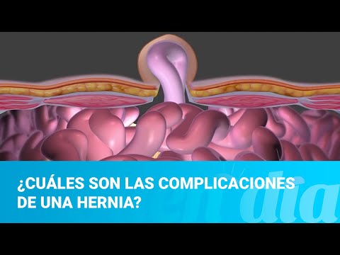¿Cuáles son las complicaciones de una hernia?