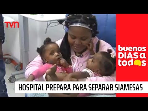 Todo está listo: Hospital Exequiel González Cortés se prepara para separar a siamesas
