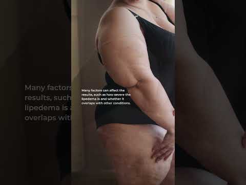 How to Spot if I have Lipedema, A painful fat disease?