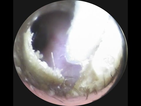 Vol.317【耳掃除】4ヶ月ぶりのリピーター様 耳そうじはearissに任せることにしました!!eariss