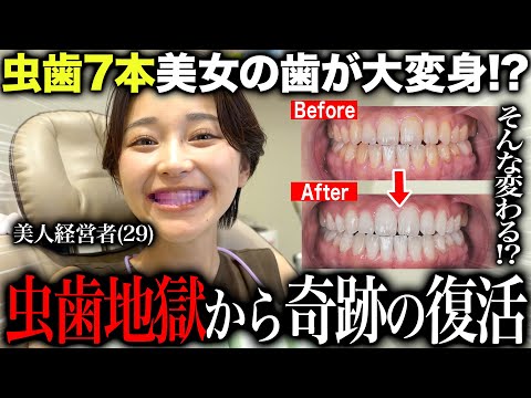 歯が腐り抜歯手術をした虫歯が７本ある美女経営者の歯の歯石チェック&ホワイトニングで大変身！？