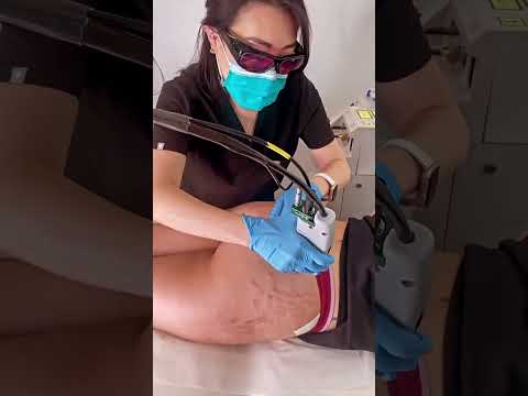 Treat Red Stretch Marks with Pulsed Dye Laser