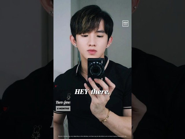 Two-jaw Surgery #kpop #idol #kstyle #korea #korean #plasticsurgery #kbeauty
