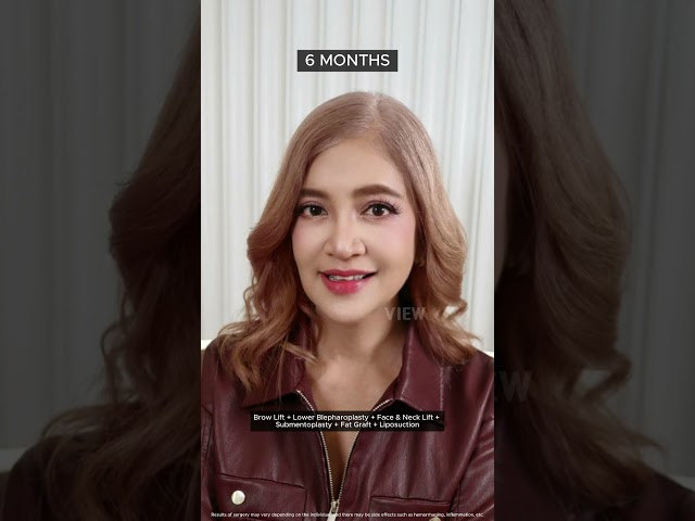 🔥 Don’t ya want to be Hot like her 🔥#browlift #facelift #antiaging #lifting #korea