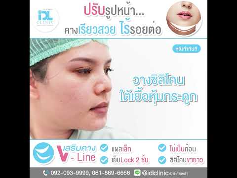 IDLReview:เสริมคาง𝑽-𝑳𝒊𝒏𝒆