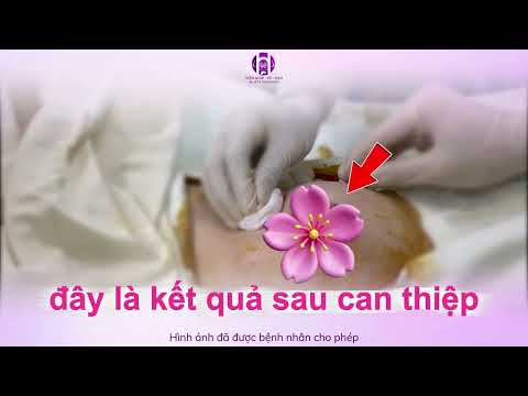 Bác sĩ ơi! Hút u vú bằng VABB có thật sự không để lại sẹo như lời đồn??