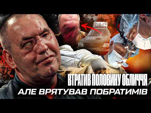 ⚡ДРОН ПОТРАПИВ В ОБЛИЧЧЯ: неймовірна історія нашого воїна. ОСЬ ЯКІ ДИВА роблять українські лікарі!
