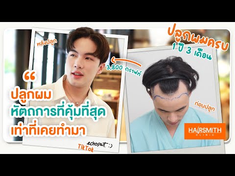 เอคโค่รีวิวปลูกผม1ปีเปลี่ย