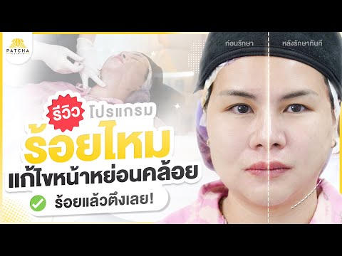 รีวิวร้อยไหมแก้ไขหน้าหย่อนคล้