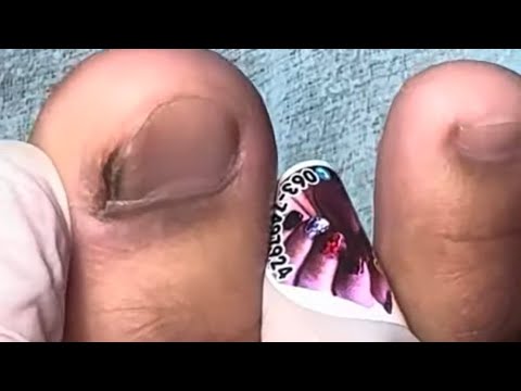 Ep_7269Footnailsskinremova