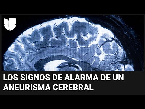 ¿Sufres de fuertes dolores de cabeza? Estos son los síntomas de un aneurisma cerebral