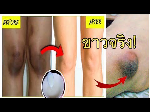 ตาตุ่มดำด้านทำไงดี-ผิวขาว-|-Ho ตาตุ่มดำด้านทำไงดี-ผิวขาว-|-Ho