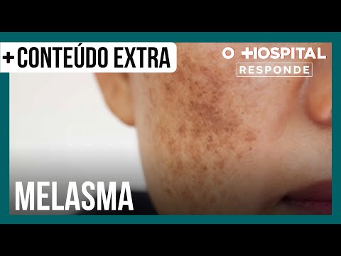 O que pode piorar o melasma? Especialista tira dúvidas | O Hospital Responde