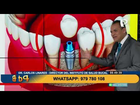 ¿Cuáles son los mejores implantes dentales?