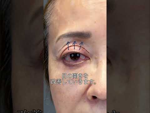 切らない眼瞼下垂で自然に若返り✨ #美容