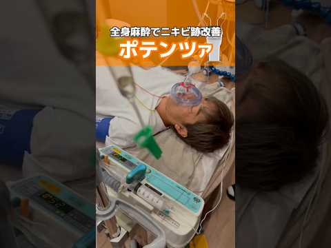 寝てる間にニキビ跡改善👍🏻 #ニキビ跡 #クレーター #ポテンツァ #全身麻酔 #shorts