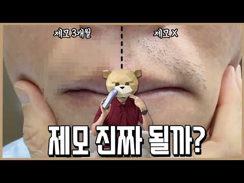 제모 진짜 될까? 3개월간 한 쪽 수염만 쏴 봄ㅣ내돈내산