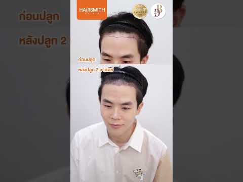 Hairsmith Clinic ปลูกผมแบบไม่ต้องโกนNonShavenFUEไม่ต้องหยุดงานไม่ต้องพักฟื้นน