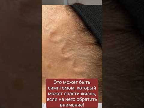 Выпуклые сосуды на висках? Срочно проверьте сосуды! Признаки атеросклероза.