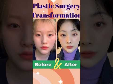 รีวิวผ่าตัดขากรรไกร-วีไลน์-ลดโ รีวิวผ่าตัดขากรรไกร-วีไลน์-ลดโ