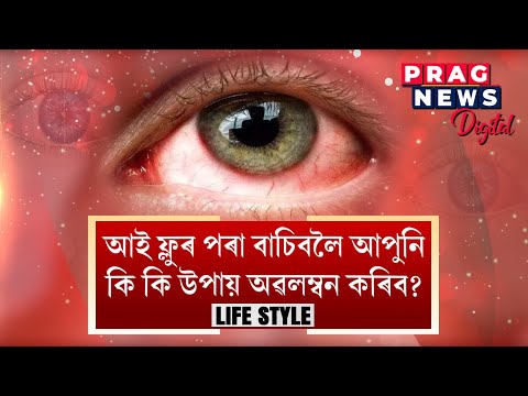 Tips to quickly cure eye flu and also prevent the pink eye infection