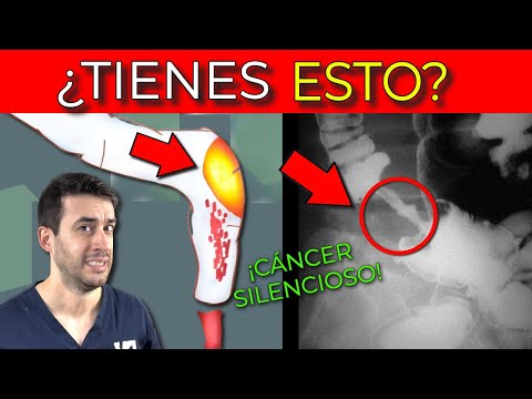 ¿Menor de 50 años? ESTO INDICA CÁNCER DE COLON (Primeros síntomas)