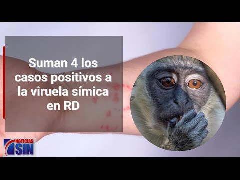 Suman cuatro los casos positivos a la viruela símica en RD