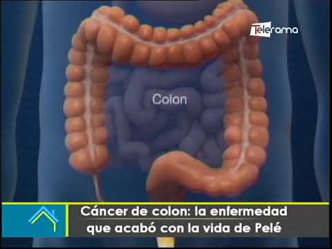 Cáncer de colon: La enfermedad que acabó con la vida de Pelé