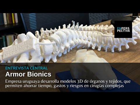 Armor Bionics: Modelos 3D para facilitar cirugías complejas (incluida una separación de siameses)