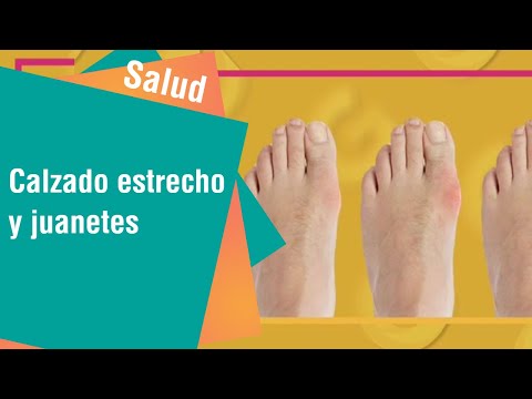 Cómo el calzado afecta la aparición de juanetes | Salud