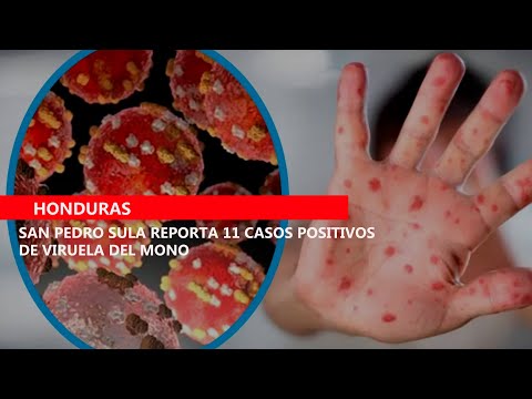 San Pedro Sula reporta 11 casos positivos de viruela del mono