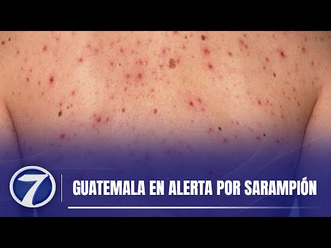 Guatemala en alerta por sarampión